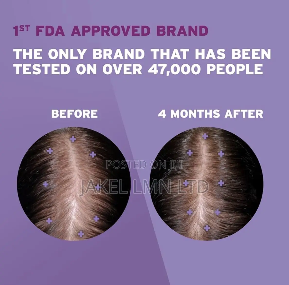 Women’S Rogaine 2% Minoxidil Topical Solution Hair Regrowth Treatment