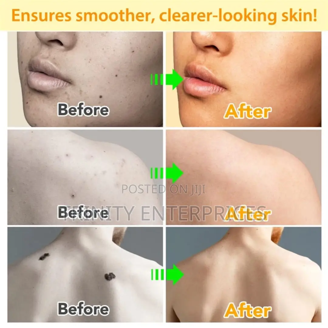 Sefudun Bee Venom Wart Remover Spray