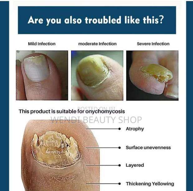 Nail Fungus Repair Ointment - thumbnail 2