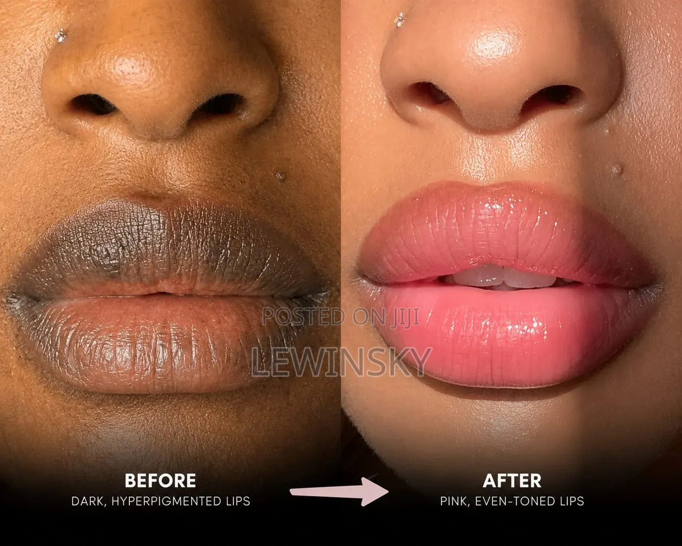 Dark Lips to Pink Lips Solution