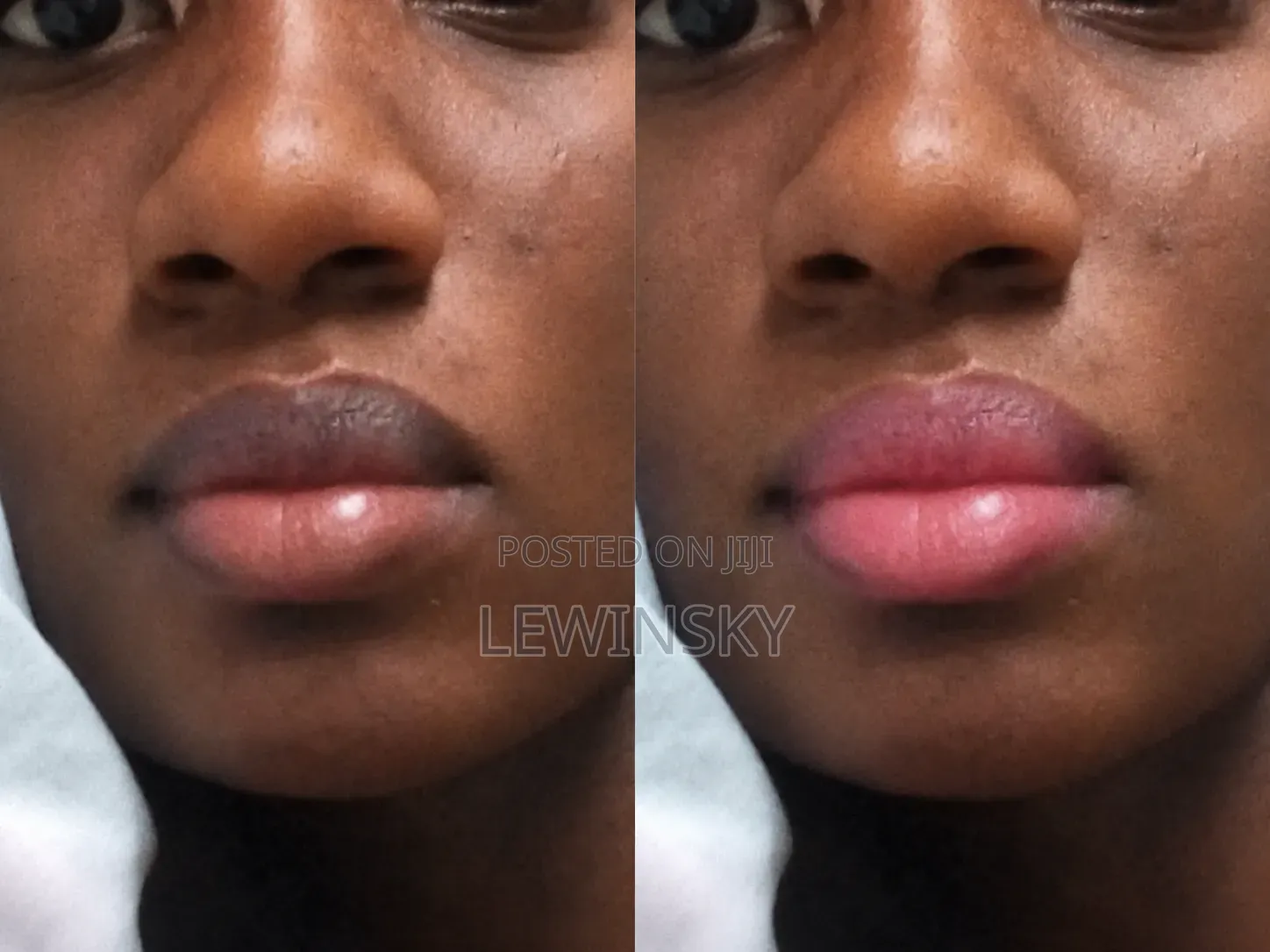 From Dark Lips to Pink,Soft and Yummy Lips