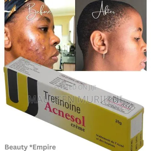 Tretinoin Acnesol Cream