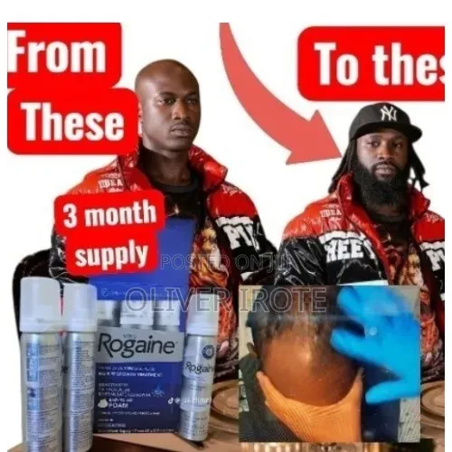 Rogaine Spray Solution