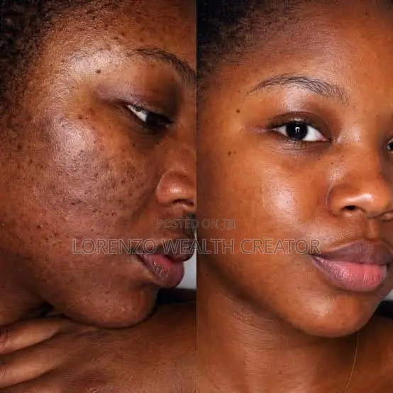 45 Day Facial Acne Pimple Removal