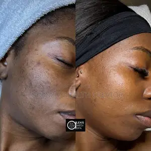 45 Day Facial Acne Pimple Removal