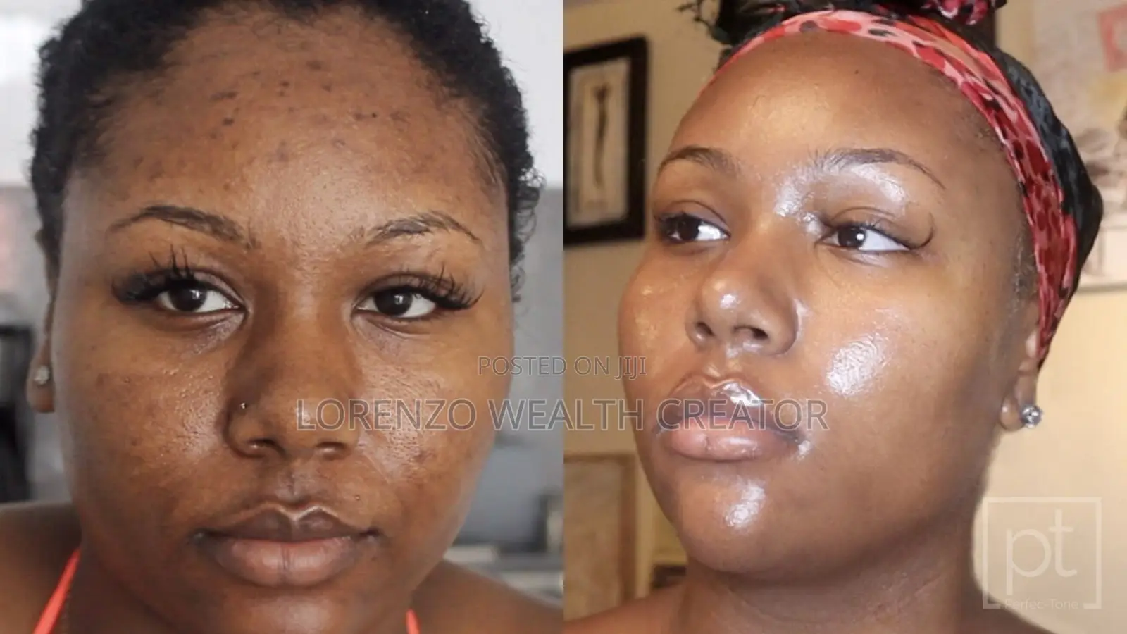 45 Day Facial Acne Pimple Removal