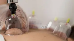 Hijama Therapy