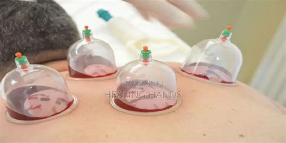 Hijama Therapy