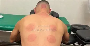 Hijama Therapy