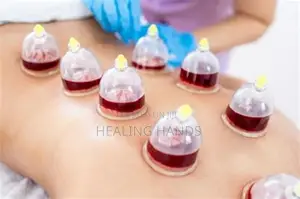 Hijama Therapy