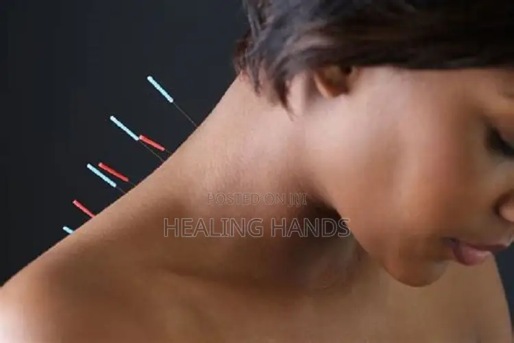 Acupuncture Treatment