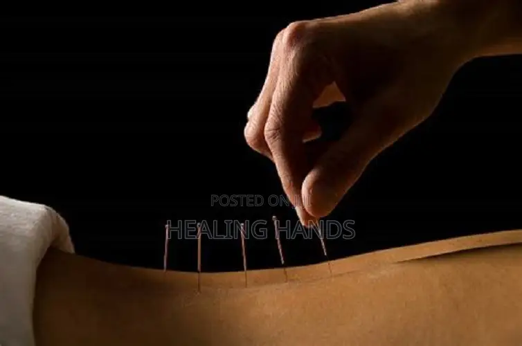 Acupuncture Treatment