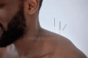 Acupuncture Treatment