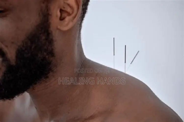 Acupuncture Treatment
