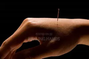 Acupuncture Treatment