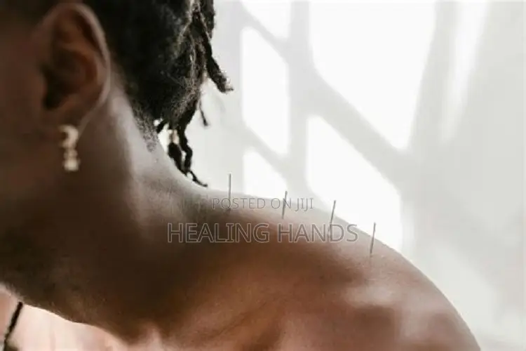 Acupuncture Treatment