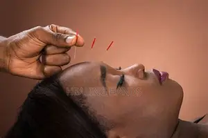 Acupuncture Treatment