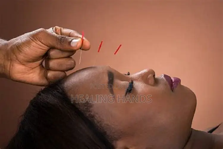 Acupuncture Treatment